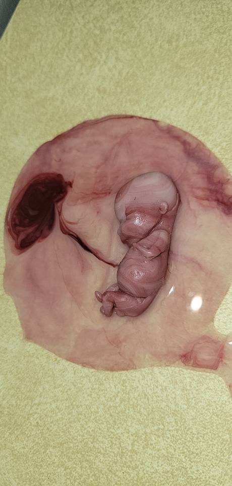 12 week gestational fetus silicone memorial baby inside silicone womb with placenta attached