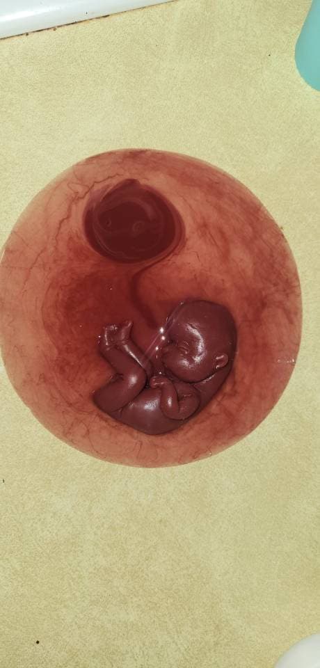 18 week gestation silicone baby in womb with placenta