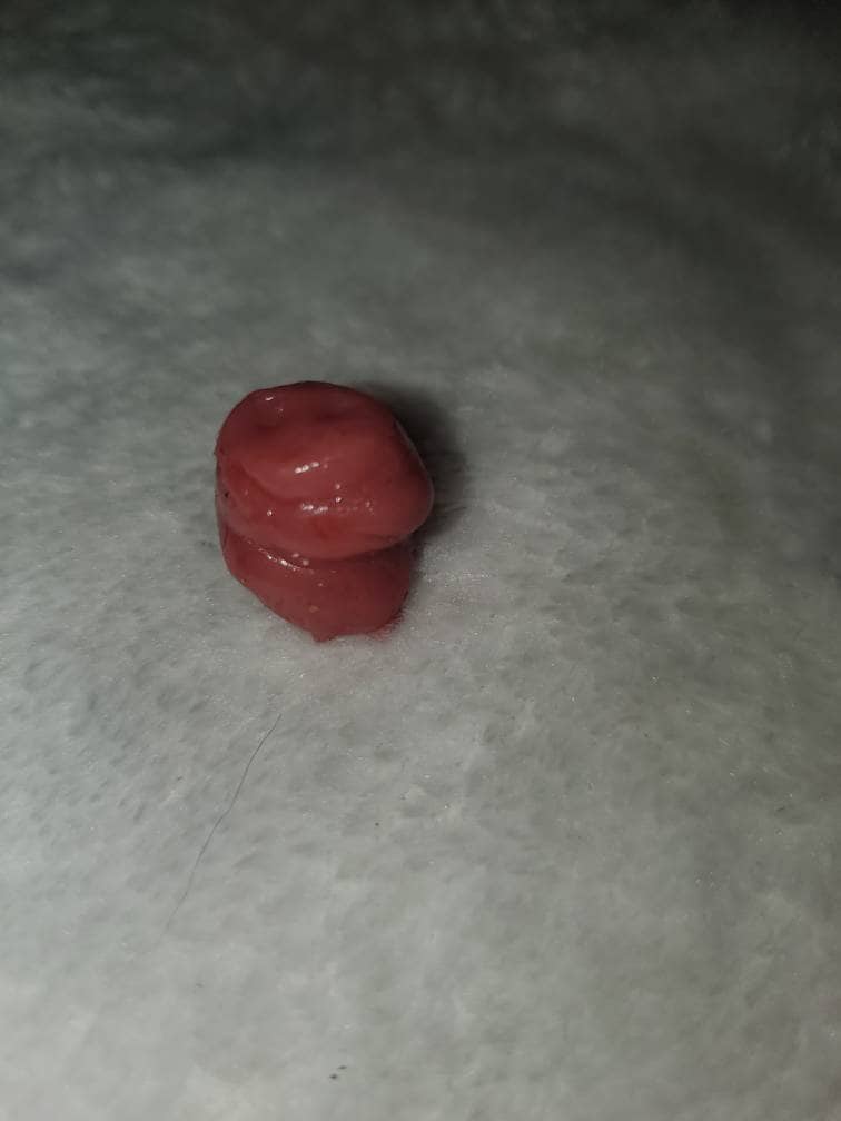 Silicone baby umbilical cord clump
